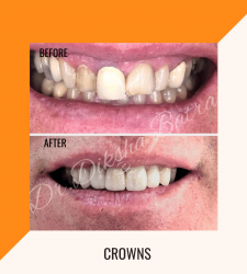 Crowns - clinic