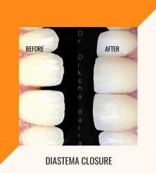 Diastema Closure