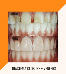 Diastema Closure + Veneers